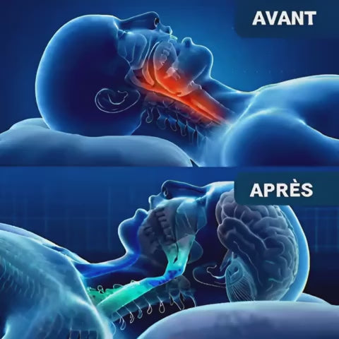 Avant / après : mâchoire en arrière et voies aériennes rétrécies, puis mâchoire maintenue et voies ouvertes avec Silenteo
